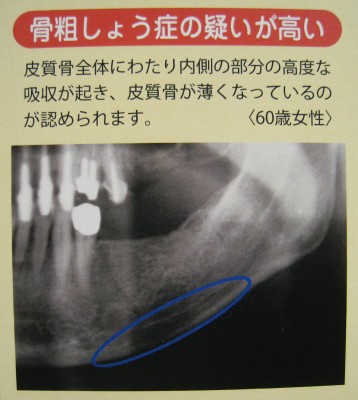 骨粗しょう症