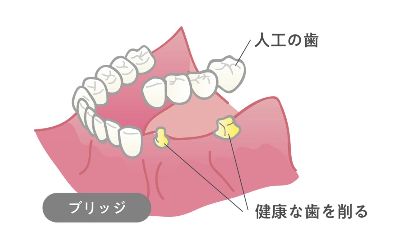 ブリッジ