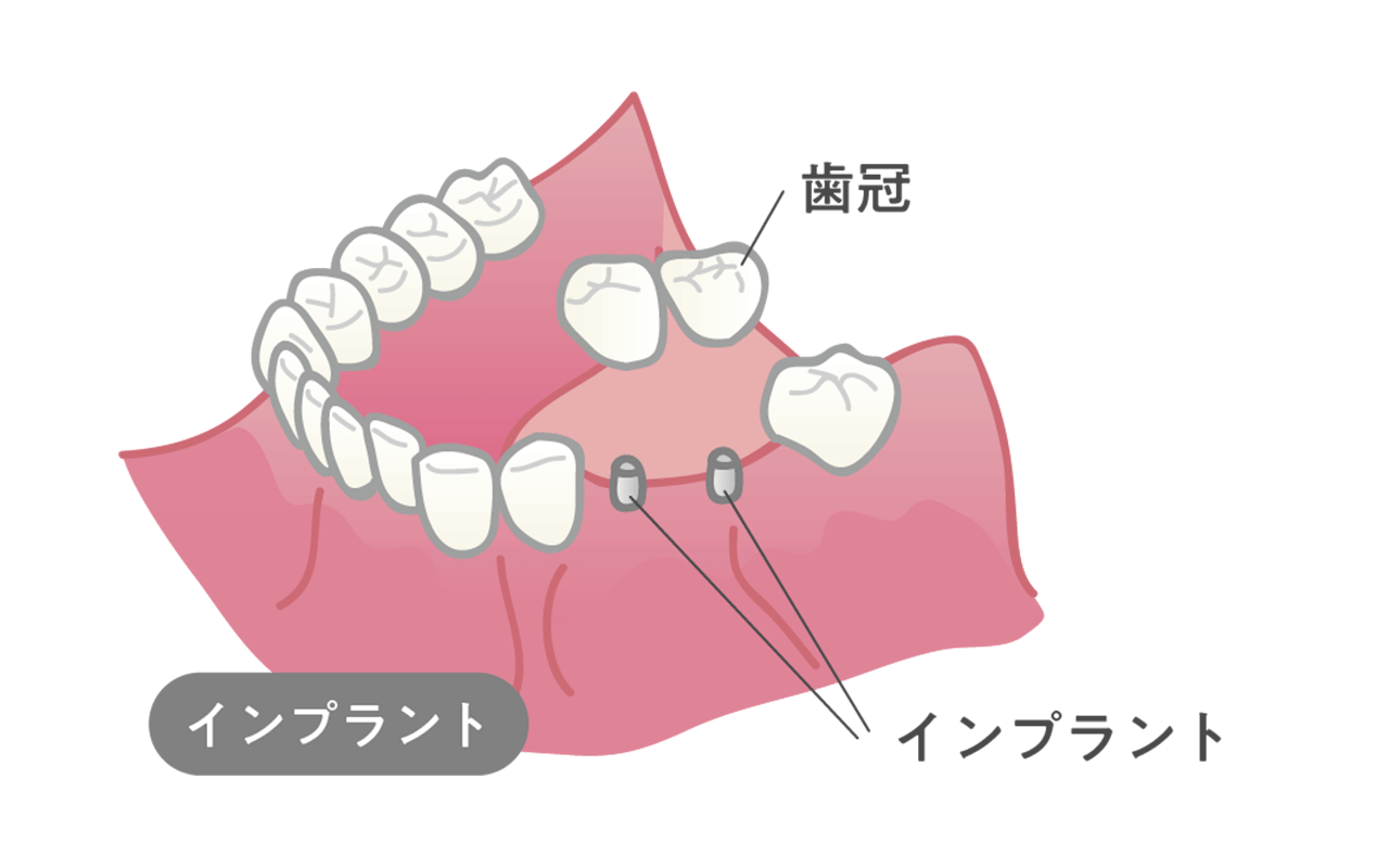 インプラント