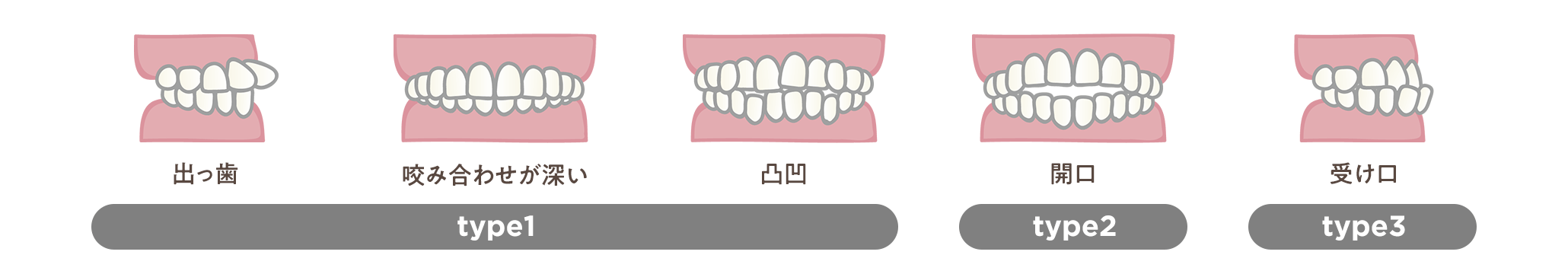 出っ歯・咬み合わせが深い・凸凹はtype1、開口はtype2、受け口はtype3
